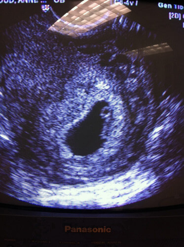 Ultrasound