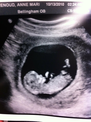 Ultrasound